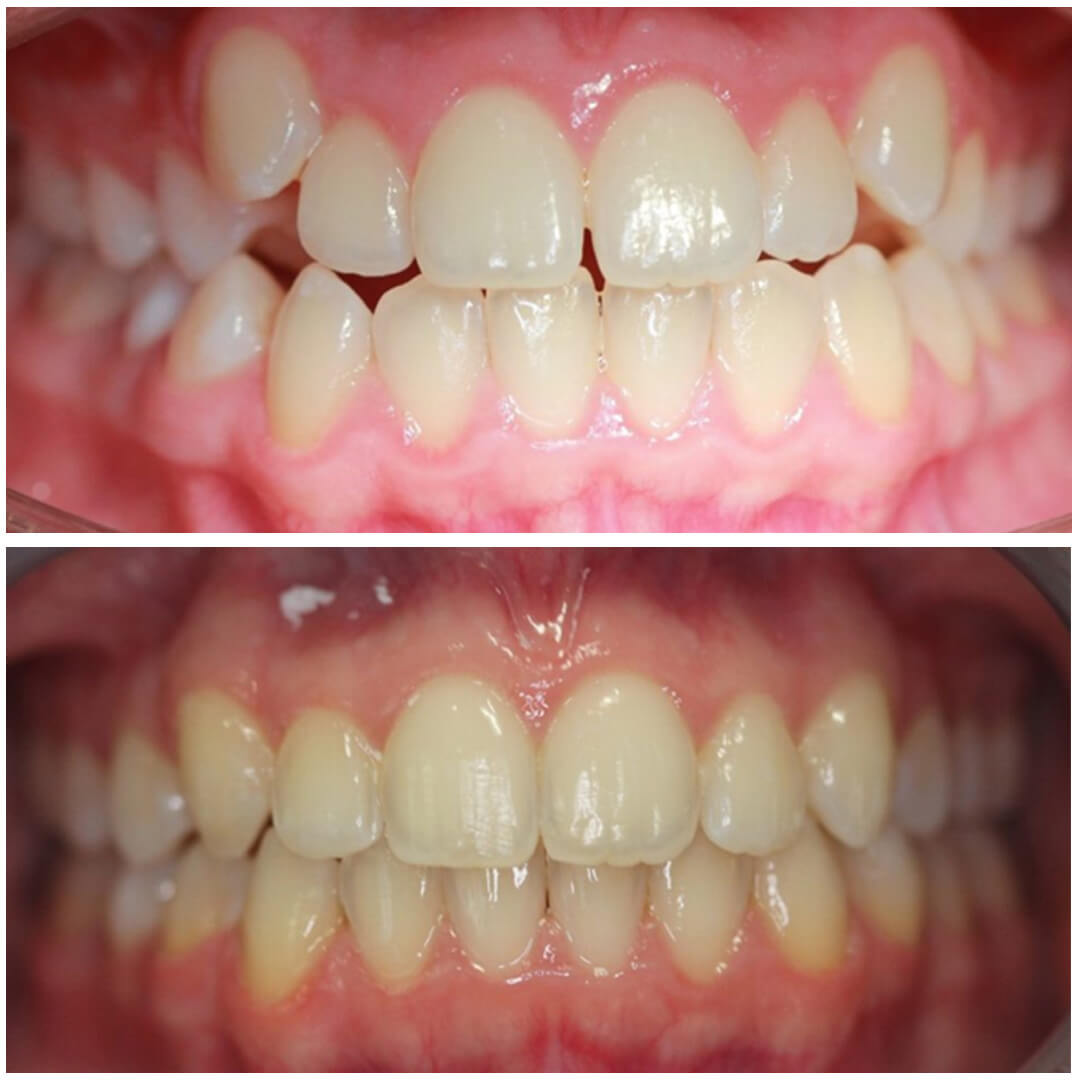 invisalign 1