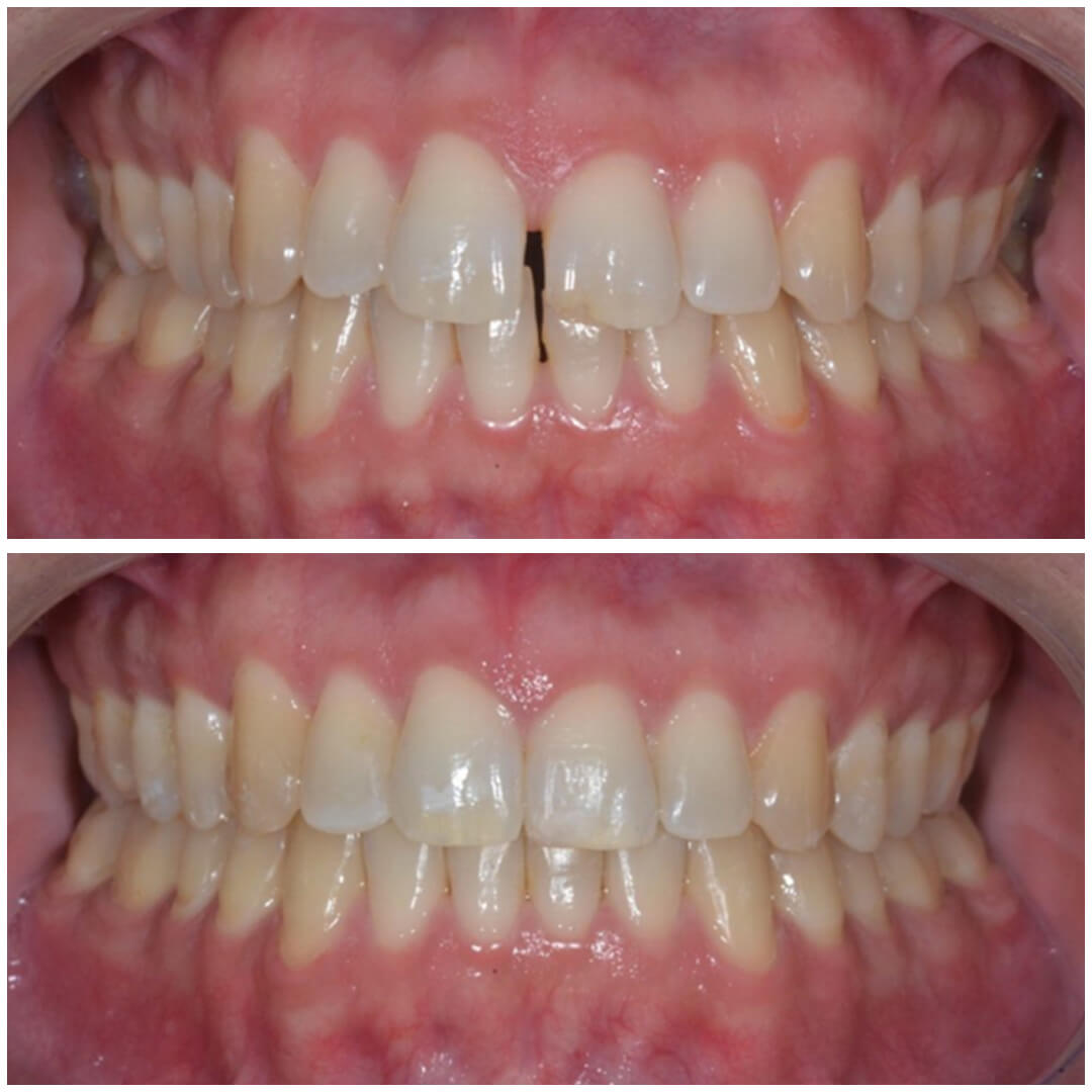 invisalign 1