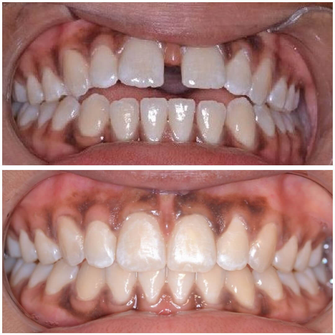 invisalign 3