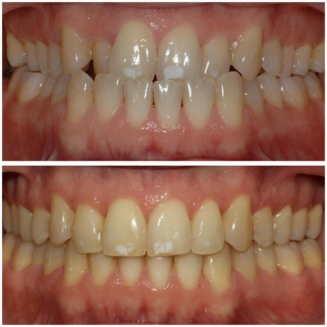 invisalign 4