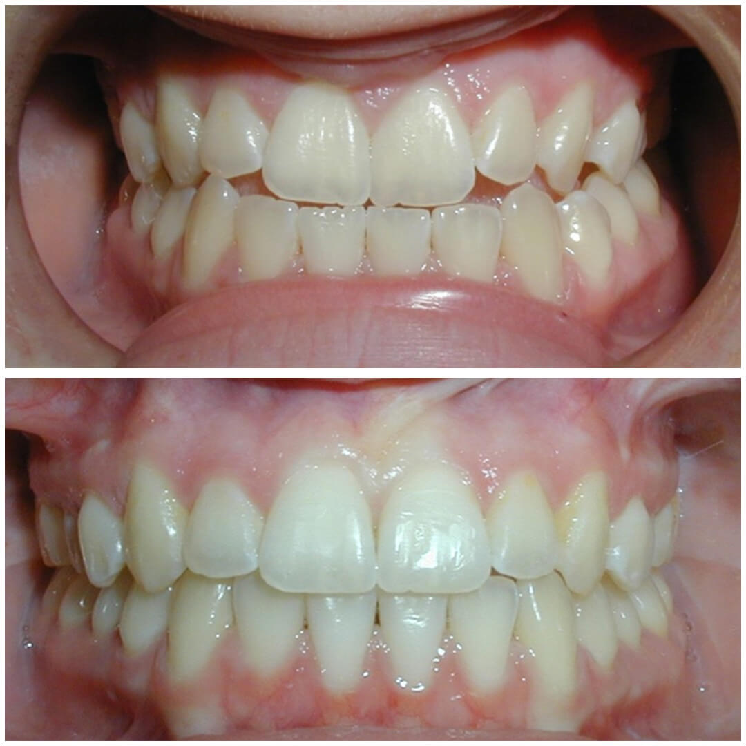 invisalign 5