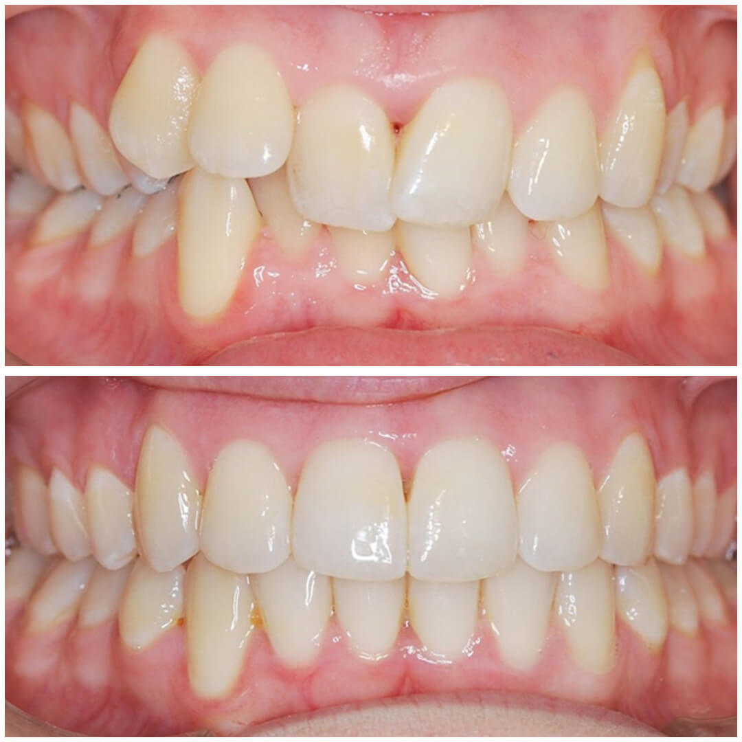 invisalign 6