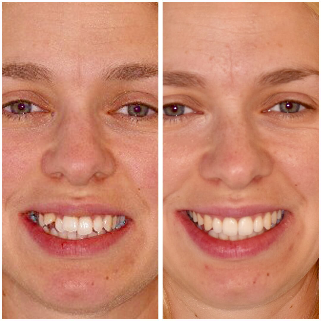 invisalign 7