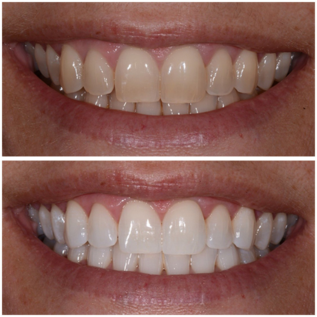 teethWhitening1