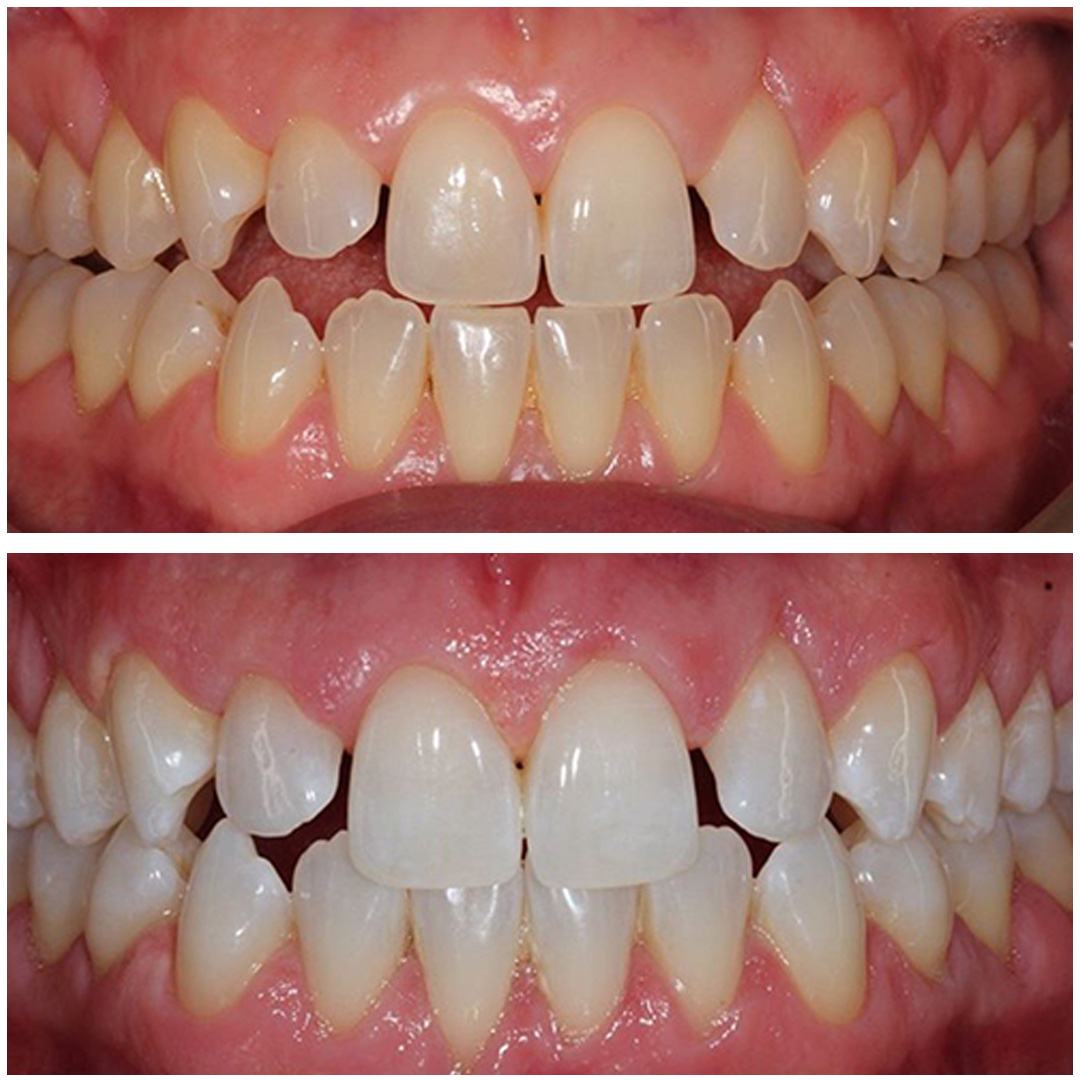 teethWhitening2